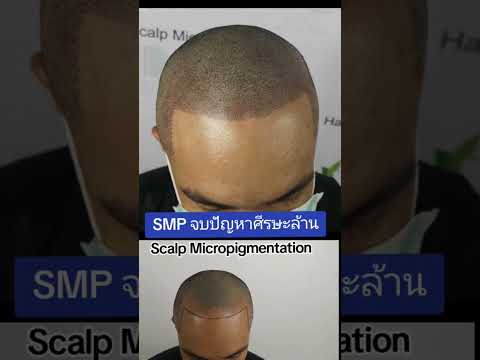 ตำรวจผมบางศีรษะล้านSMPช่วย