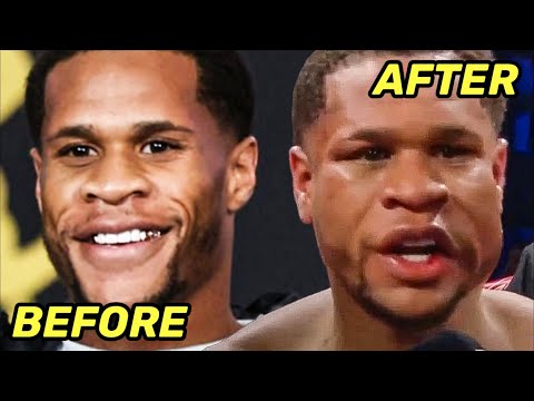 Devin haney before & after getting busted up & beaten by ryan garcia