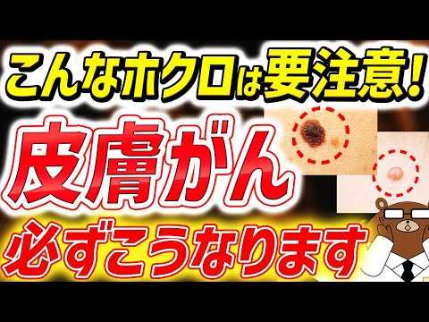 【猛暑の紫外線が危険】日本で激増している皮膚がんの超意外な初期症状とは。なる人の共通点は。体のこんな「ほくろ」は絶対見逃さないで！皮膚がんの「ABCDEサイン」とは。予防法は？医師が徹底解説！