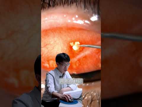 眼睛是非常重要的器官😣有任何不適請不要猶豫！儘速就醫！#蕭家杰醫師 #高雄眼科醫師 #屏東眼科醫師 #大學眼科 #過敏性結膜炎