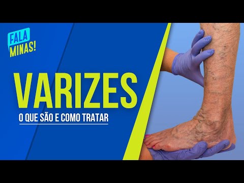 VARIZES: O QUE SÃO, QUAIS AS CAUSAS, SINTOMAS, TRATAMENTOS E PREVENÇÃO