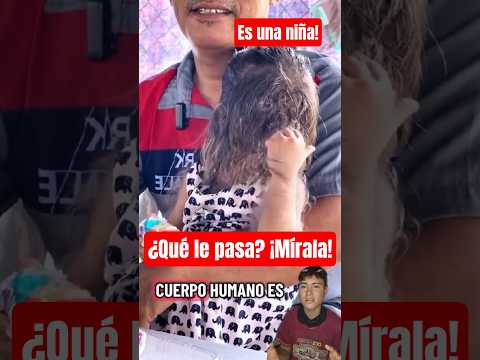 DATO CURIOSO: La Niña con el Rostro Completamente Velludo