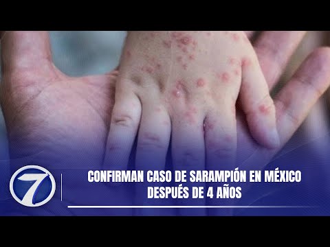 Confirman caso de sarampión en México después de 4 años
