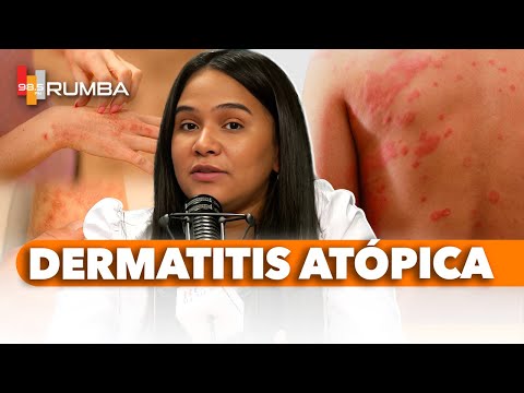 Las manifestaciones de la dermatitis atópica suelen aparecer desde los dos meses de edad.