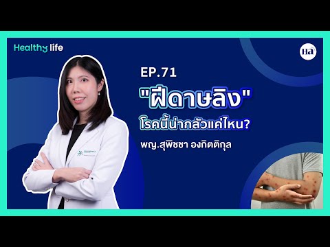 HealthyLife[EP.71]:“ฝีดาษล