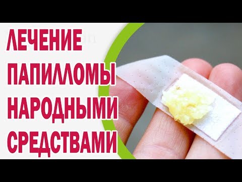 Что делать если появились папилломы