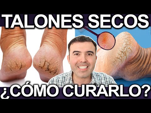 COMO CURAR LOS TALONES SECOS Y AGRIETADOS - Regenera La Piel De Tu Talon Y Elimina Los Callos