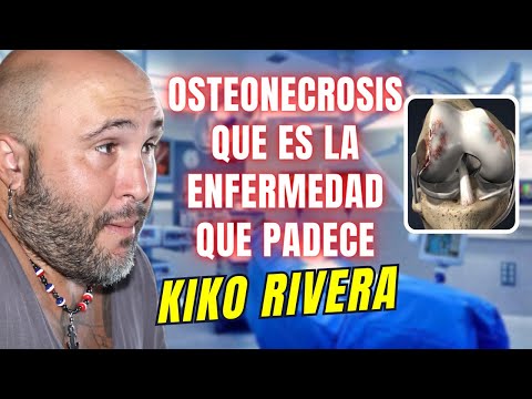 OSTEONECROSIS: La ENFERMEDAD que padece KIKO RIVERA qué es esta ENFERMEDAD
