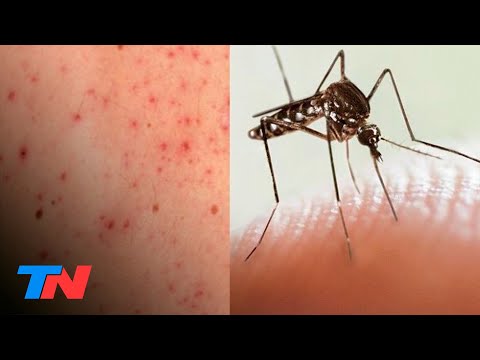 Alerta sanitaria | Preocupación por las muertes por sarampión y dengue: ¿cómo prevenirlas