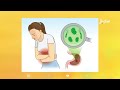 جرثومة المعدة مرض صامت قد يطول معاناته