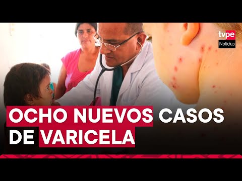 Junín: se registran ocho casos de varicela en niños y jóvenes