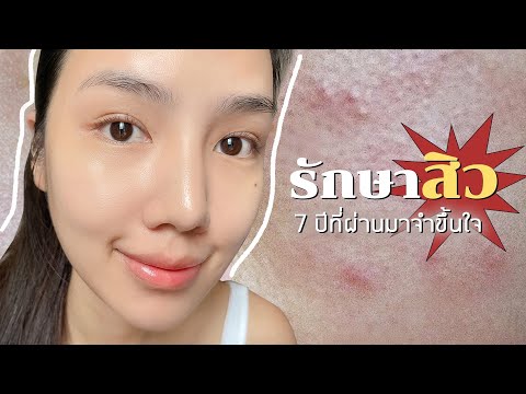รักษาสิวด้วยตัวเอง-และเรื่องรา รักษาสิวด้วยตัวเอง-และเรื่องรา