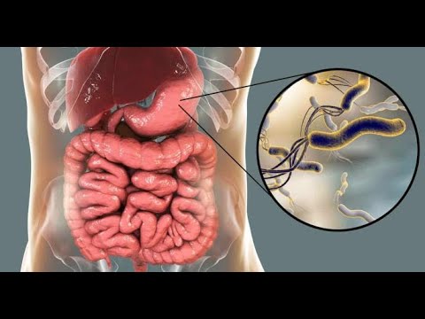 Dr. Jaime Manzanarez nos habla sobre Helicobacter pylori y su relación con la Gastritis