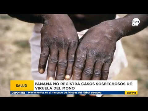 Panamá no presenta ningún caso de viruela de mono