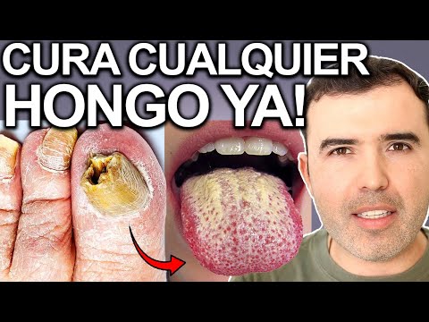 CURA CUALQUIER HONGO YA! - Como Eliminar Y Hacer Una Limpieza De Hongos