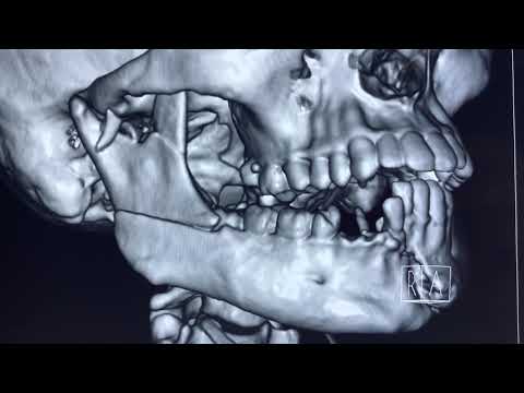 CT Scan Showing Multiple Levels Mandibular Fracture - Just Before Operating