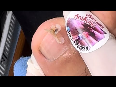 Ep_7100Footnailsskinremova