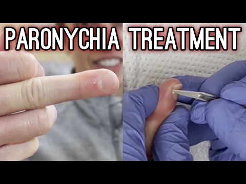 SATISFYING Drainage of Infected Cuticle | Paronychia Treatment  - #TheBubbaArmy
