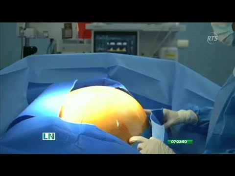 Extirpan un tumor de 13 kilos en el Hospital de Monte Sinaí
