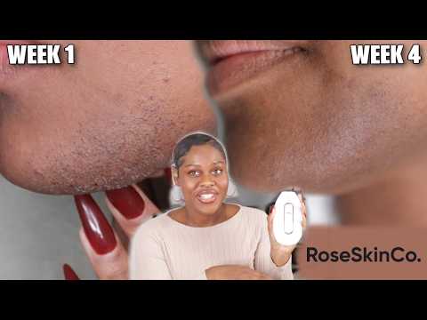 I TRIED LUMI 2 IPL ON MY PCOS CHIN HAIR 🧔🏾‍♀️ Ft RoseSkinCo