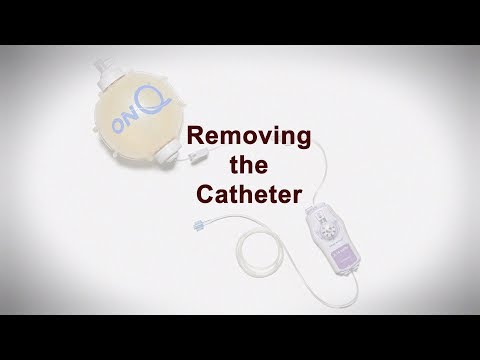 Removing Your Child's Peripheral Nerve Catheter