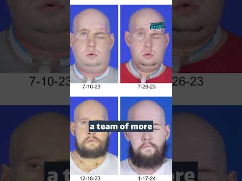 Doctors ‘truly amazed’ by man’s recovery after world-first whole-eye transplant #itvnews #news