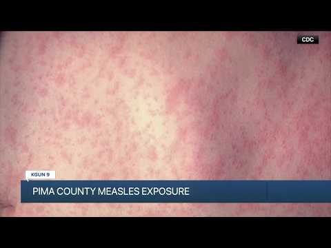Measles in Pima County: Were you exposed?