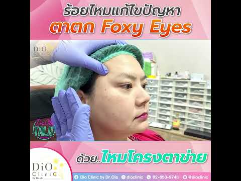 ร้อยไหมแก้ไขปัญหาตาตกFoxyEye