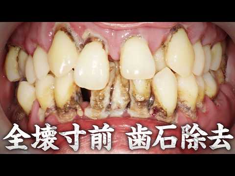 重度歯周病の恐怖😱ほとんどの歯が抜歯に⁉️