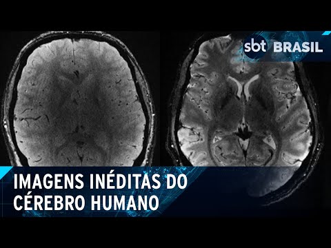 Cérebro humano tem imagens inéditas divulgadas | SBT Brasil (02/04/24)