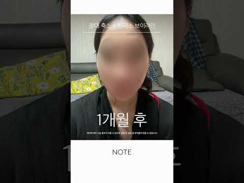 [noteprs] #광대축소 #핀리스브이라인 #노트성형외과