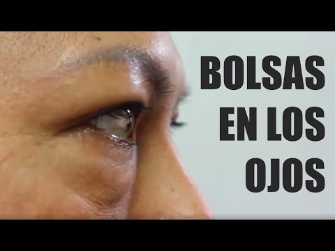 BOLSAS en los ojos ? CIRUGIA de PARPADOS INFERIORES   BLEFAROPLASTÍA ? DR PERCY NEVADO ALBÁN