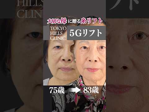 👩🦳大切な母に贈る糸リフト🪡 『5Gリフト』