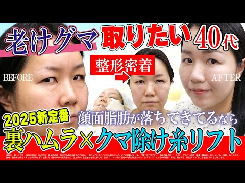 【2025年クマ取り裏ハムラの効果を上げる方法】40代からはクマよけ糸リフトで中顔面をバシッと上げると満足感が爆増します【クマ取りダウンタイム記録】湘南美容クリニック