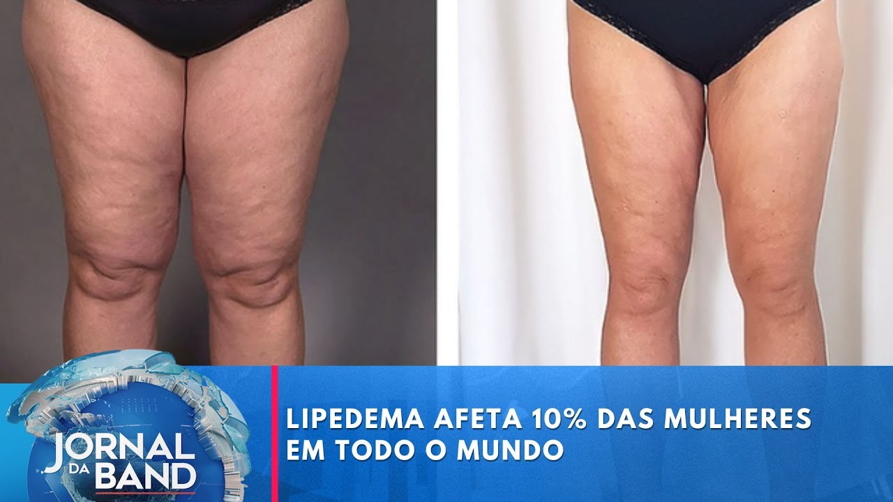 Lipedema afeta 10 das mulheres em todo o mundo | Jornal da Band