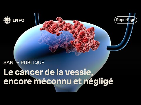 Le cancer de la vessie, encore méconnu et négligé