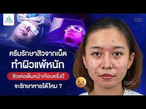 หน้าพังแพ้ครีมในเน็ตสิวเห่อเต