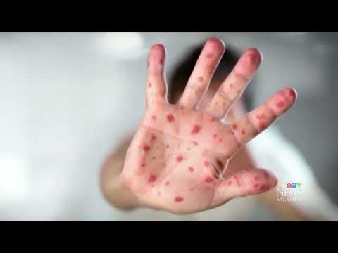 50 confirmed measles cases in N.B. as outbreak worsens