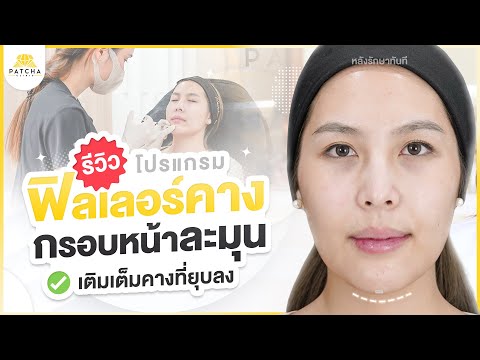 รีวิวฟิลเลอร์คางแก้ปัญหากระเป