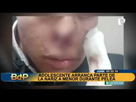 OFF Junín arrancan parte de nariz a joven en pelea