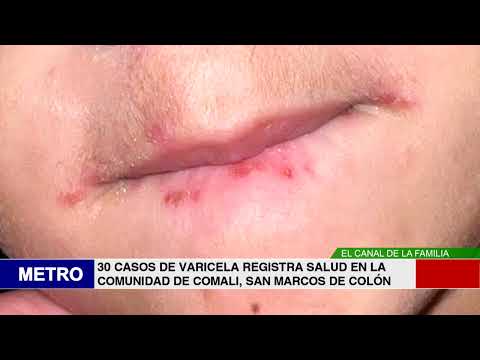 CASOS DE VARICELA REGISTRA SALUD EN LA COMUNIDAD DE COMALI, SAN MARCOS DE COLÓN