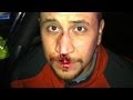 Caller: Zimmerman Bloody Nose Theory