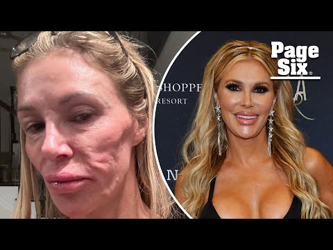 Brandi Glanville ‘lost 5 teeth’ while battling facial disfigurement