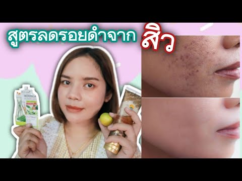 สูตรเด็ด-DIY-ลดรอยดำ-รอยแดง-แล สูตรเด็ด-DIY-ลดรอยดำ-รอยแดง-แล