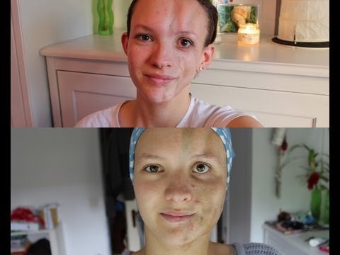 VLOG #2 Gesichts OP, Urlaub, und mehr | ObviouslyAdri