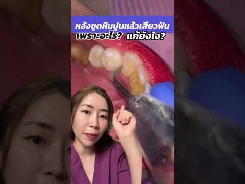 หลังขูดหินปูนแล้วเสียวฟันเพรา