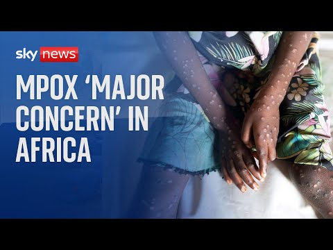 Mpox 'major concern for Africa' as WHO declares global health emergency