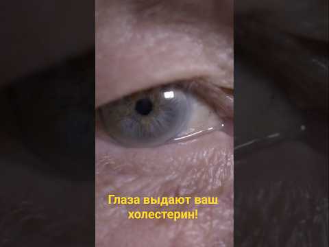 2 признака ХОЛЕСТЕРИНА на лице 👁️ 2 Facial Signs of High Cholesterol