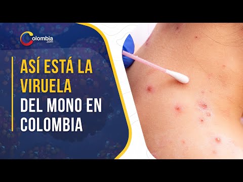 Colombia se encuentra en una fase de contención de la viruela símica: Minsalud.