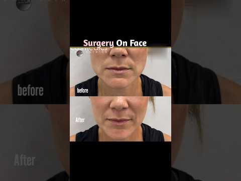 Bollywood Actors Who have Undergone Face Surgery 💫 #Shorts